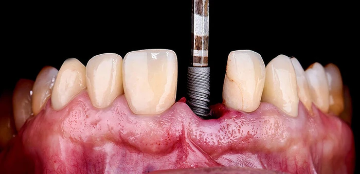 EZ_Implantat_AdobeStock_271071343-cs.jpg (Bild: ©Garo - stock.adobe.com) EZ_Implantat_AdobeStock_271071343-cs.jpg (Bild: ©Garo - stock.adobe.com)